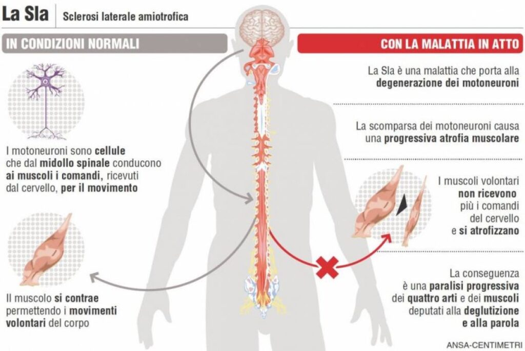 SLA – Sclerosi Laterale Amiotrofica - Aisla Firenze